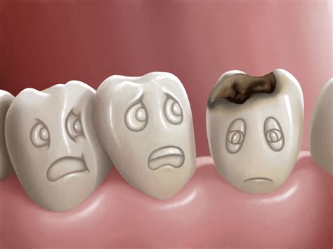 Common Causes & Treatments of Tooth Decay | Polished Dental Studio