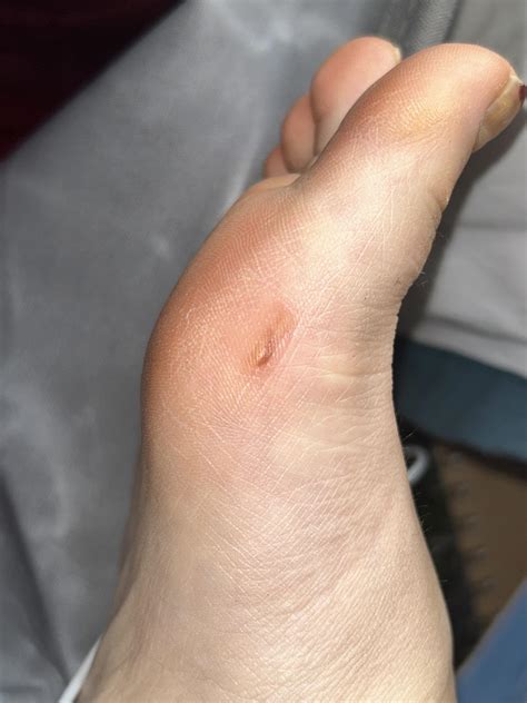 Sudden raised line on side of foot - suspicious? : r/AskMedical