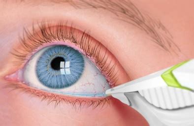 tearlab osmolarity test  diagnostic tool  dry eyes