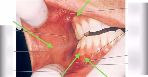 oral cav 2 Diagram | Quizlet