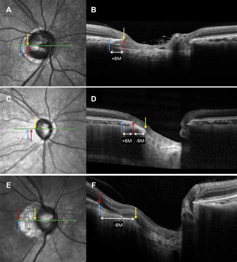 microstructure  peripapillary atrophy  subsequent visual field