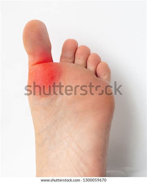 hallux varus   images shutterstock