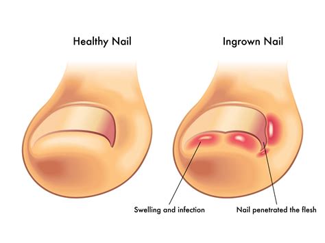 Prevention & Treatment Ingrown Toenail with Dr. Evan Lewis