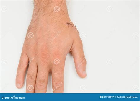 Close-up of a Hand Wound with Stitches Stock Image - Image of finger ...