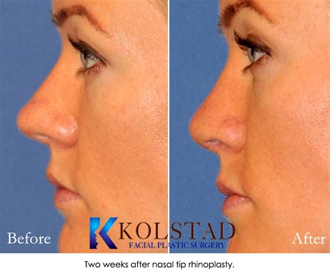 Bulbous Tip Rhinoplasty La Jolla Before & After Gallery 1 | Dr. Kolstad ...