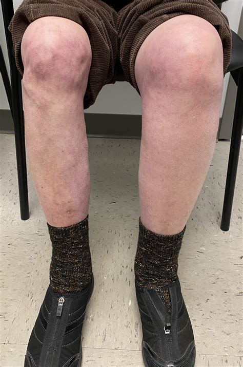 Deep Vein Thrombosis (DVT) - BEVSA - Buffalo Endovascular & Vascular