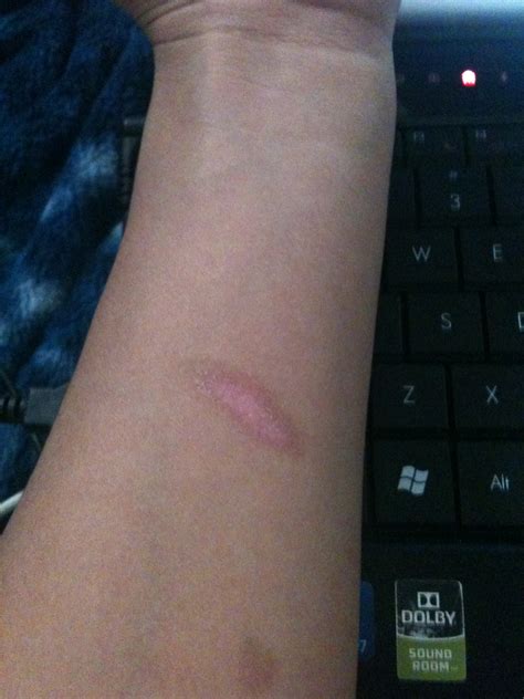 Cherry pit dangers are being highlighted by health experts this summer 29