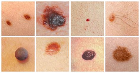 Skin Moles Types