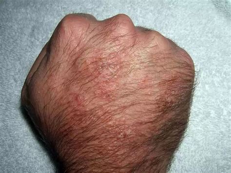 Large Study Reveals Connection Between Atopic Dermatitis and Celiac ...