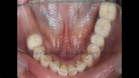 teeth implants madhav dental clinic