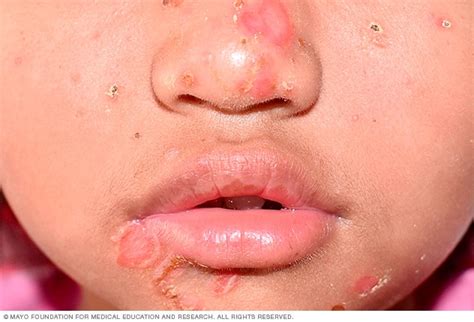 Impetigo - Symptoms & causes - Mayo Clinic