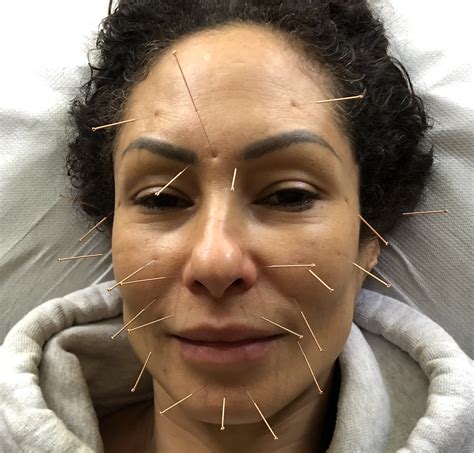 Facial Rejuvenation Acupuncture - Wimbledon Acupuncture & Herbs facial