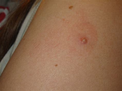 Hard White Bump On Arm