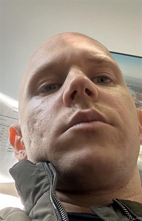 Subcision and fillers : r/AcneScars
