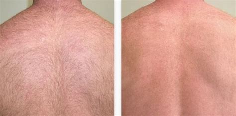 Laser Hair Removal Before and After - Dermatology Center of Atlanta
