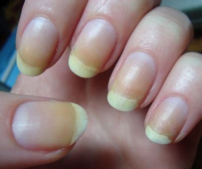 Unha Amarela O Que Pode Ser - Unhas amarelas: O que pode ser? Como clarear