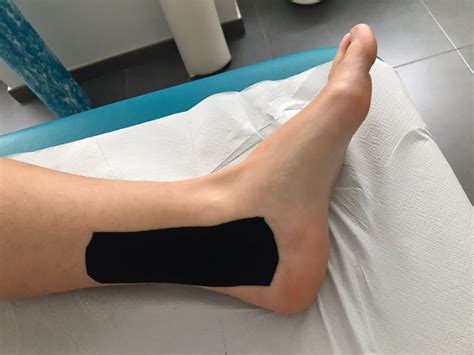 Posterior Tibial Tendonitis