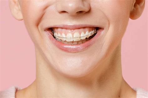 behel keramik kelebihan kekurangan pemasangan dll  sehat