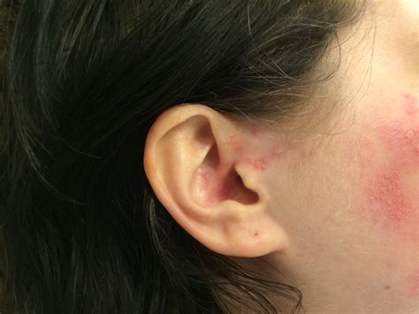 Ramsay Hunt Syndrome Type 2 The First Sign Of Recovery After Bell's