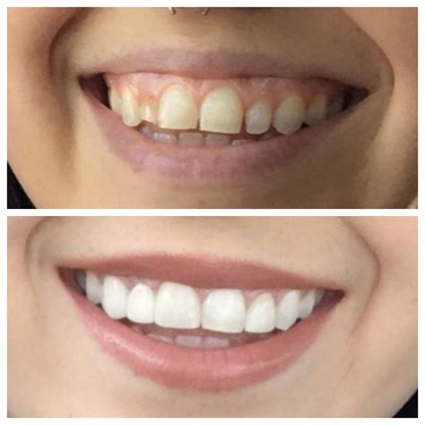 how to fix your smile shape