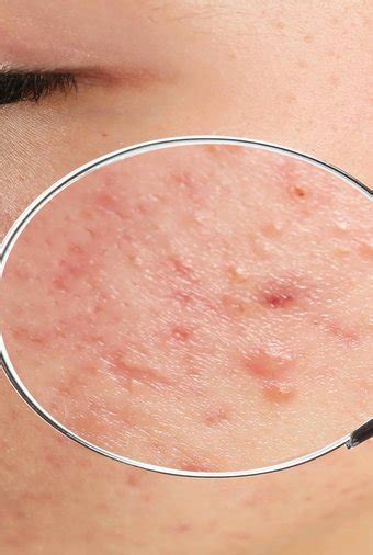 Cravo Branco No Rosto - Cravos brancos e pretos: como tirar cravo branco do rosto | L'Oréal Paris