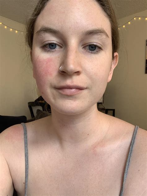 1110 best r/rosacea images on Pholder | Been two weeks on Noritate 1%