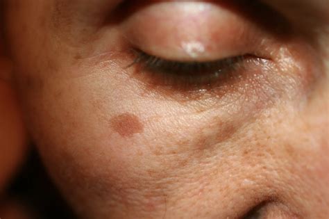 uneven skin tone treatment skincare product australia qr