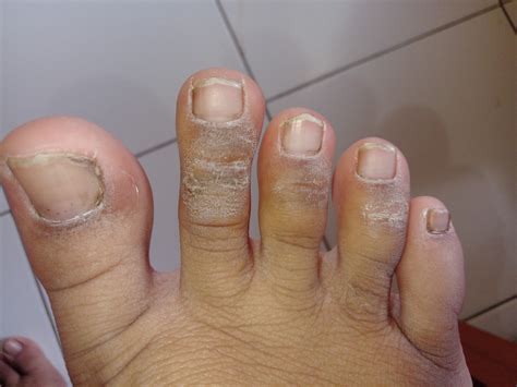 masalah  kaki hellosehat