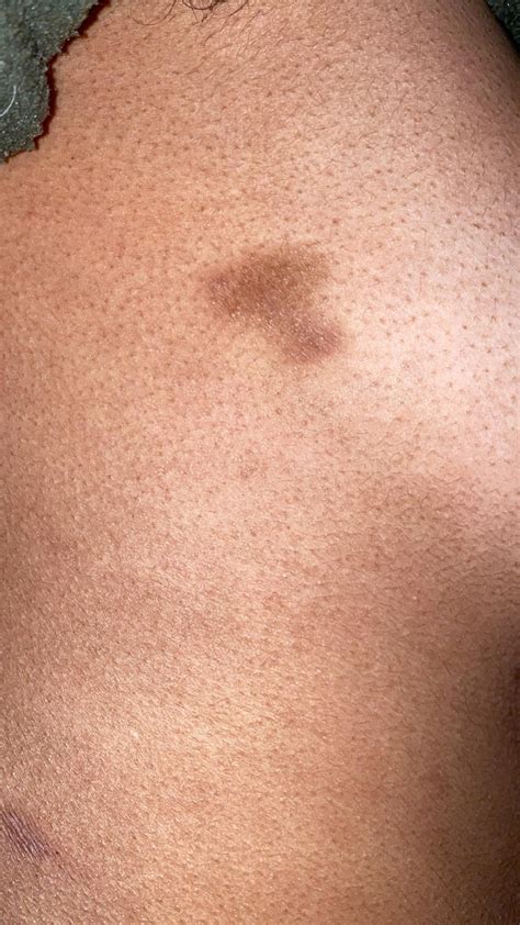 Ringworm? Fungal infection? : r/DiagnoseMe