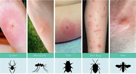 pictures    id   common bug bites  summer