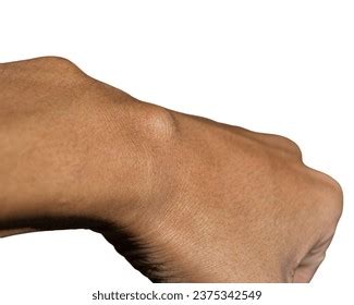 finger ganglion cyst stock   images shutterstock