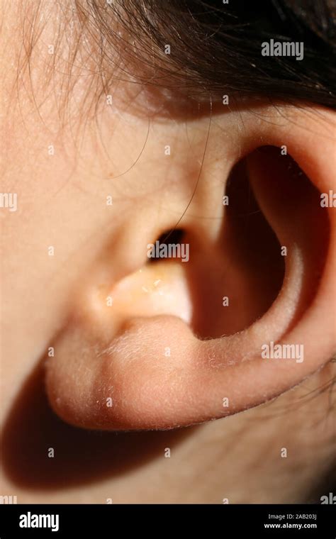 deformed ear abnormal development   auricle plastic surgery