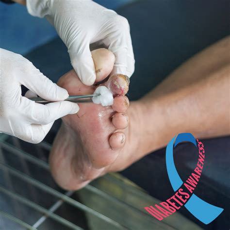 5 Tips for Effective Wound Management in Diabetic Patients - Shop With ...