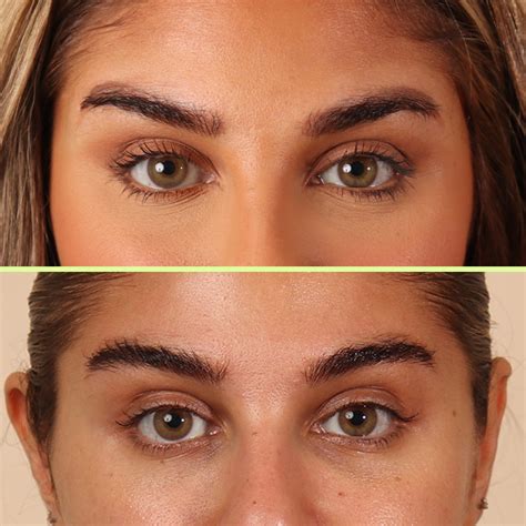 Eyebrow tattoo removal