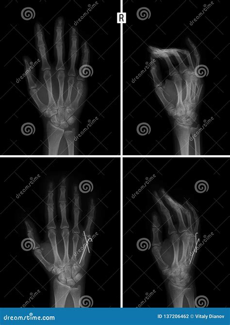 X-ray of the Hand. Fracture of the 5rd Metacarpal Bone. Reposition ...