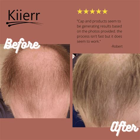 LLLT for Hair Growth - The Science Behind Laser Hair Treatment
