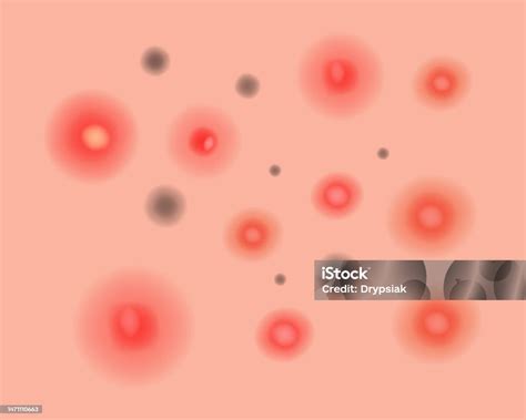 types  acne diagram skincare problems  inflammation acne skin