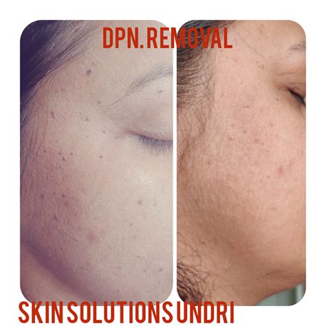 #DPN Removal... - Skin Solutions - Skin& Hair Clinic