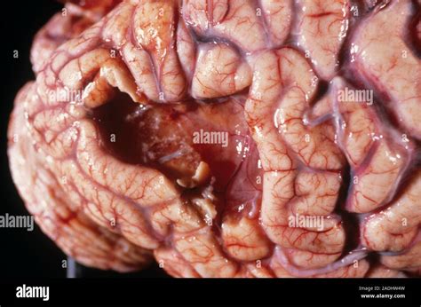 Brain damage. Gross specimen of a brain showing damage to an area of ...