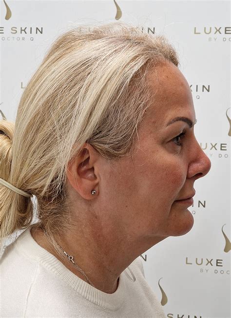 lift  glasgow  surgical face  neck lift