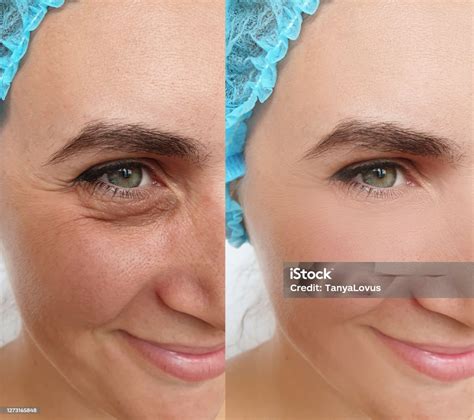 Enrugar Ou Enrrugar - Foto de Mulher Enrugar Antes E Depois Da Colagem Tratamento e mais ...