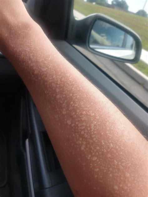 The way my sweat droplets formed blisters under a dead layer of skin