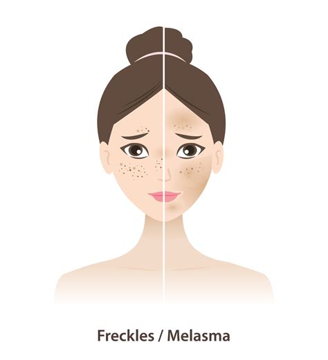 comparación de pecas y melasma en piel mujer cara ilustración aislado