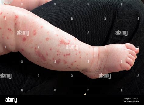 chicken pox close    chicken pox rash   leg    month