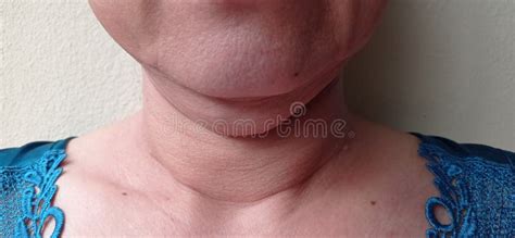 A Woman Whose Neck Has Sagging Skin. Stock Photo - Image of pink, mouth ...