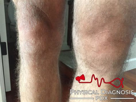 synovitis physical diagnosis pdx