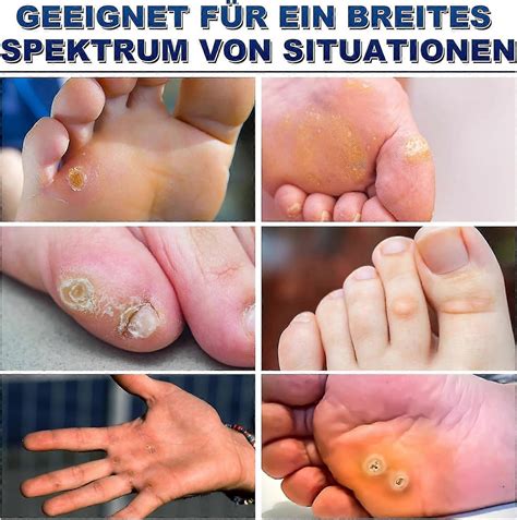 Plasters, Corns Removal Pads, Sponge Corns Remover Plasters, For Feet