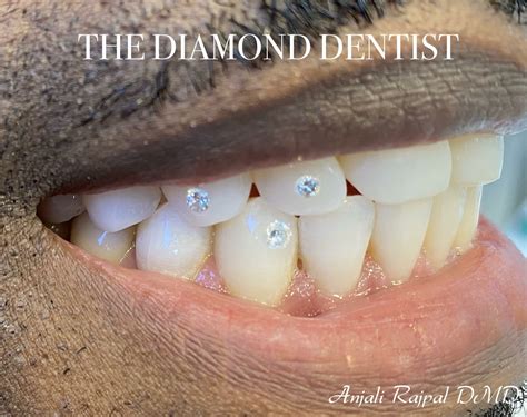 diamond tooth implant