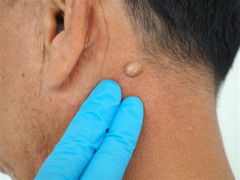 What is a Sebaceous cyst? - Diamond Skin Care