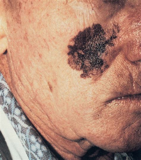 Skin Cancer Melanoma